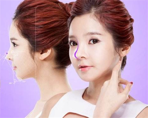 韩国芭比小翘鼻手术是鼻综合吗?