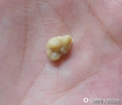 多年的口臭原因竟是喉咙里卡了它,去医院一查医生都吓一跳