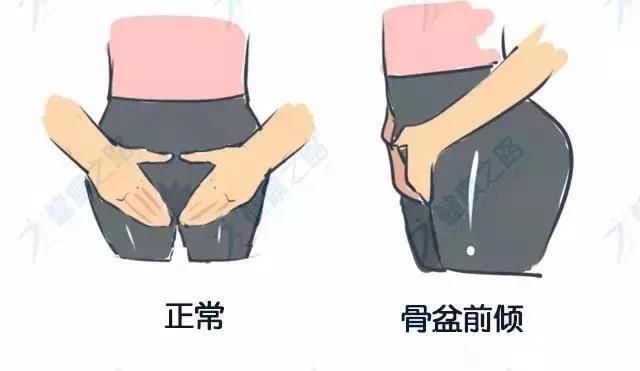 你以为的翘臀,90%是骨盆前倾,危害不小.