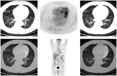查出肺结节千万不能傻傻等待!