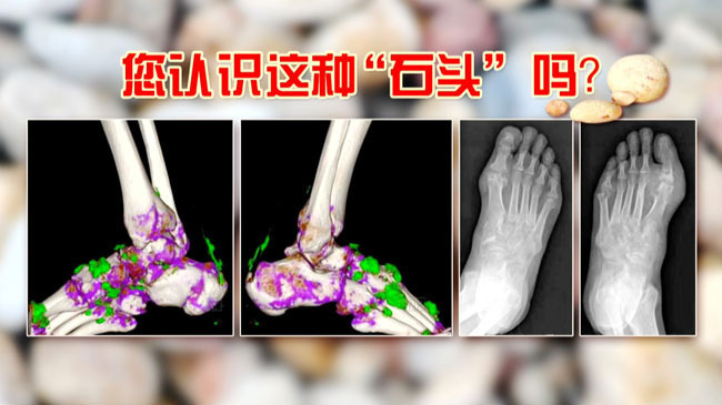 《养生堂》警惕会“吃人”的石头