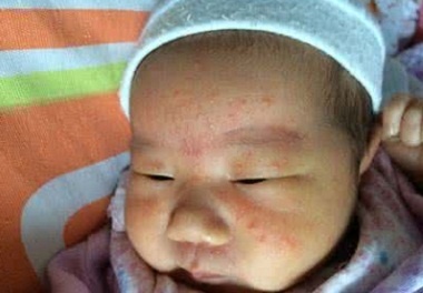 婴儿湿疹:怕热、怕干、怕过敏 治疗宝宝湿疹的