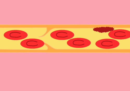 人体能自动消除血栓吗?防血栓,记住357