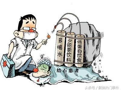 震惊!56岁大妈右肾切除2980颗肾结石!什么样的