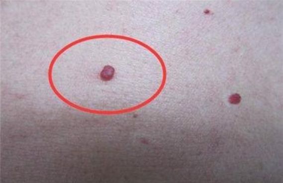 身上长了很多小红点,轻压会褪色,不痛不痒的是