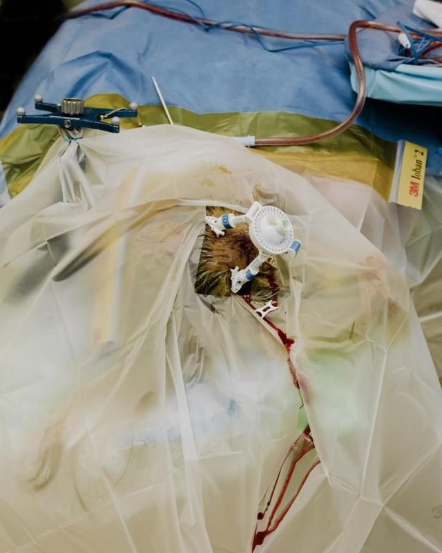 癫痫、中风让患者离不开医院?只需脑植入芯片