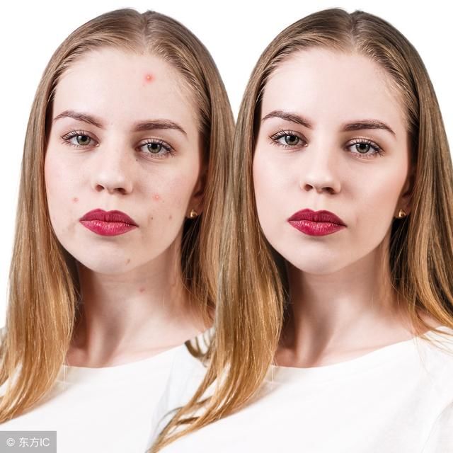 成年人脸上不停长痘?痘痘告诉你,身体哪里出了