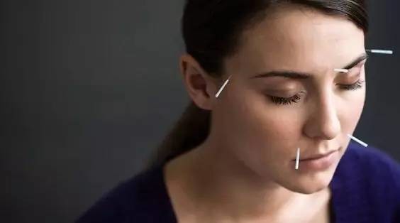 熊黛林为什么要给自己扎针?原来面部针灸可以