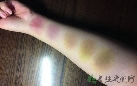 皮肤容易淤青与白血病的关系