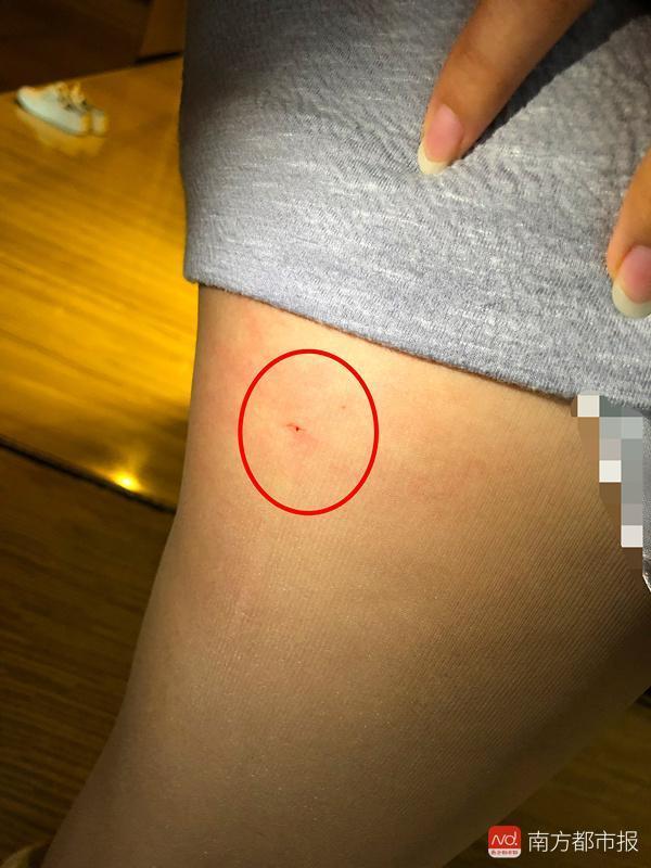 星级酒店床垫藏针扎破女生大腿!酒店免房费不担感染风险