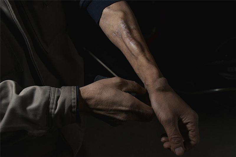 老人收尸20年, 手臂染上"尸毒"不敢靠近周围人