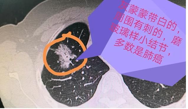 CT肺部有小结节是肺癌吗?这样的小结节最危险