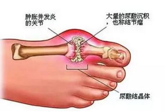 痛风最有效的降尿酸方法是常吃一种食物,中医