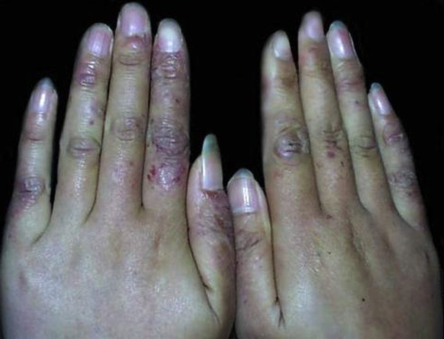 手背上怎么会长湿疹呢?有可能是这些原因?