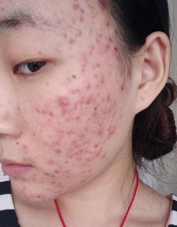 为什么身边有的人不起痘痘呢?