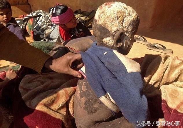 据社交媒体了解,在印度的偏远山村就有这么一位7岁的"石头人"男孩,只