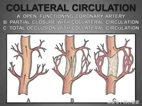 让堵塞的心脏血管重焕"生机",心内科专家教你建立侧支循环!