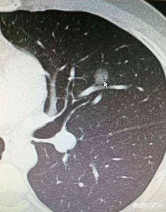 肺原位癌图片图片