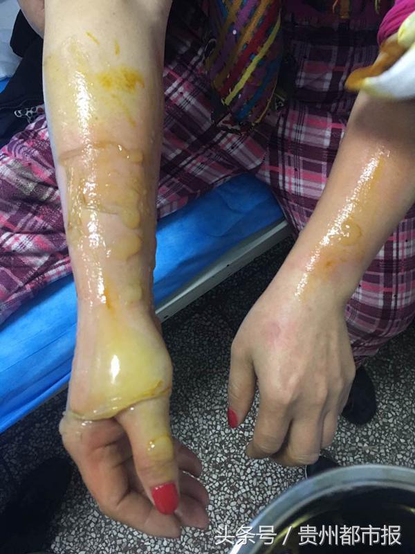 当高温油遇到冰冻汤圆!贵阳两市民医院过元宵节