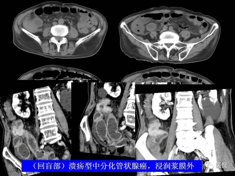 实战病例丨急性阑尾炎的鉴别诊断#医学影像#