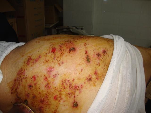 蛇缠腰缠腰一圈会死人?