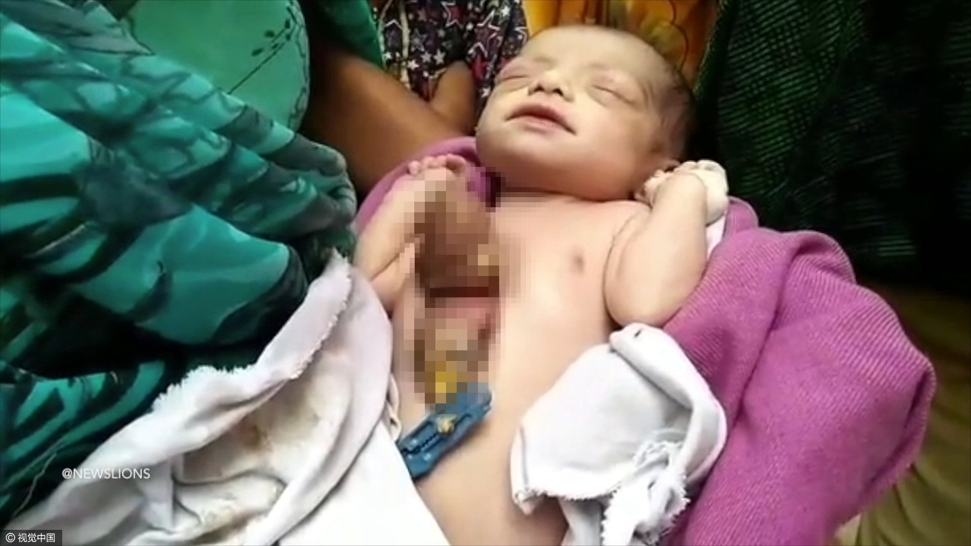 2017年4月11日讯，印度克久拉霍，一位22岁的妈妈生下了一个女婴，她的心脏长在胸外，仅有50%的存活几率。这个女婴叫 Hemlata 和大部分新生儿不一样，她的心脏竟长在胸外部，也就是心脏异位。这种情况每八百万个孩子中才会有一例。