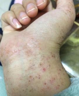 慢性湿疹是一种过敏性皮肤病,其发病部位常见于脸部,耳后,四肢屈侧