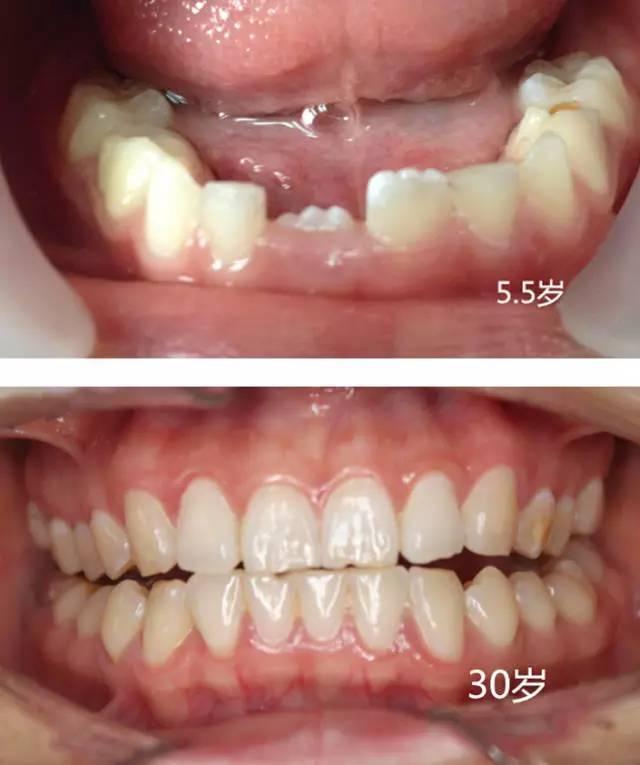 乳牙还不掉?换牙期都需要注意什么问题呢?#叶子口腔科普