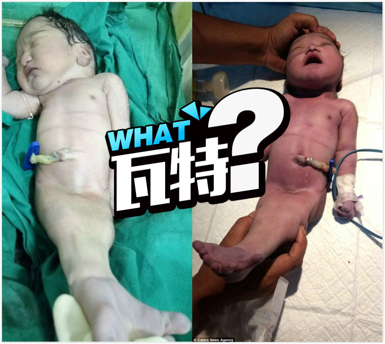妈妈生下美人鱼宝宝，概率十万分之一