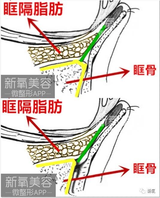 眶隔脂肪解剖图-千图网