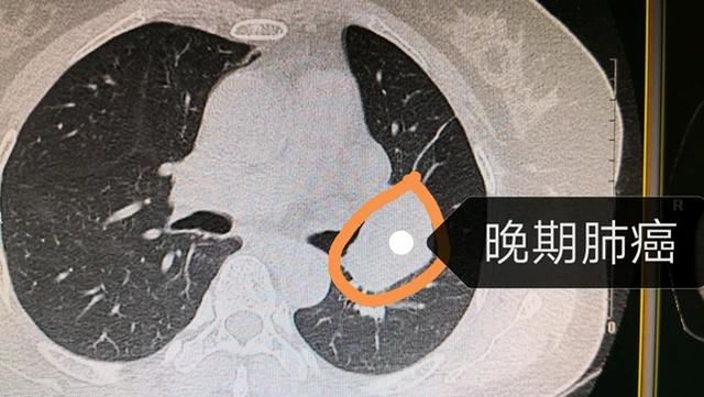 CT肺部有小结节是肺癌吗?这样的小结节最危险