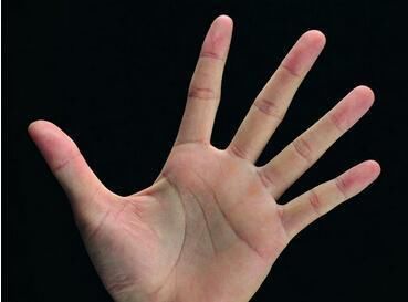 肝脏有没有病,伸出你的手掌看看就知道了,超实