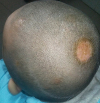 头癣起因,亲身经历教你一招祛除