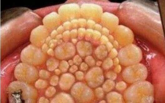 女童嘴里几天就长满了几百颗牙齿,医生看到女