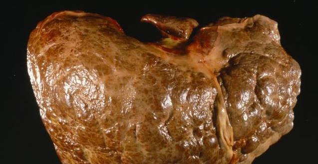 喝酒后身体这2个地方发红的人,不能喝酒,肝脏