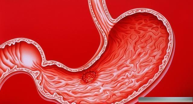 早晚喝几口,消灭幽门螺旋杆菌,胃病好了,口臭也