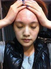 用农村老人一偏方,快速止痒,5年湿疹不再来!