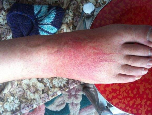 脚上湿疹治疗方法有哪些?再不祛湿走路都难-北