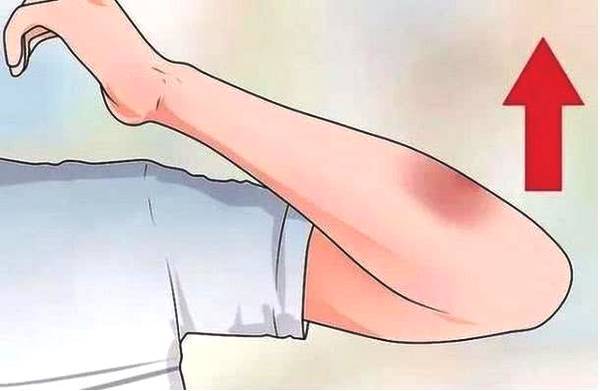 身上莫名出现淤青是鬼捏青?遇到这些情况要小