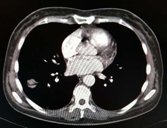 二期梅毒肺损害一例,驱梅治疗后好转