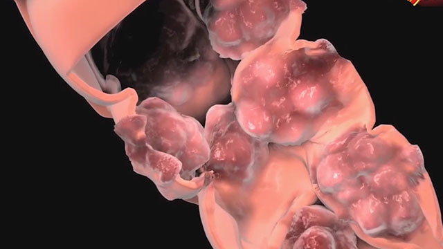 《养生堂》20180210被治愈的晚期肿瘤 《养生堂》20180210被治愈的晚期肿瘤