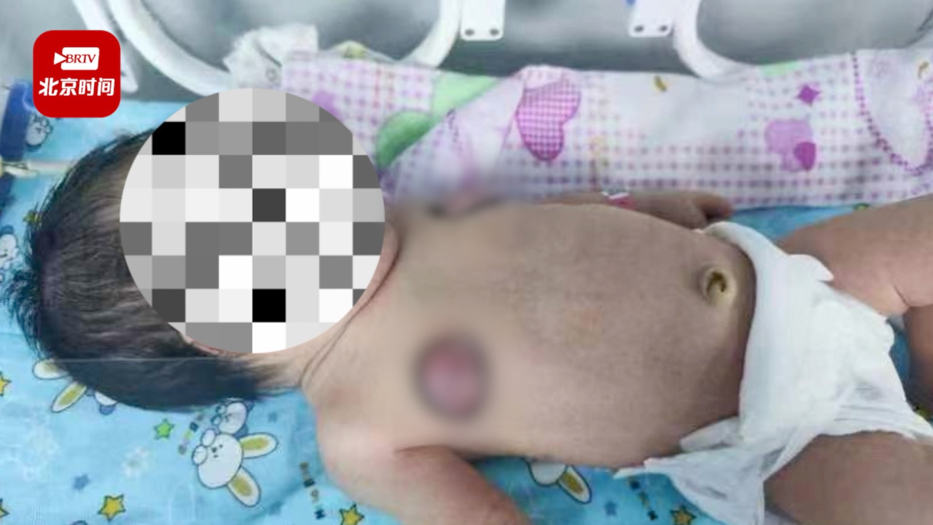 出生仅9天宝宝患急性乳腺炎 医生：家长思想落后，用手挤的！