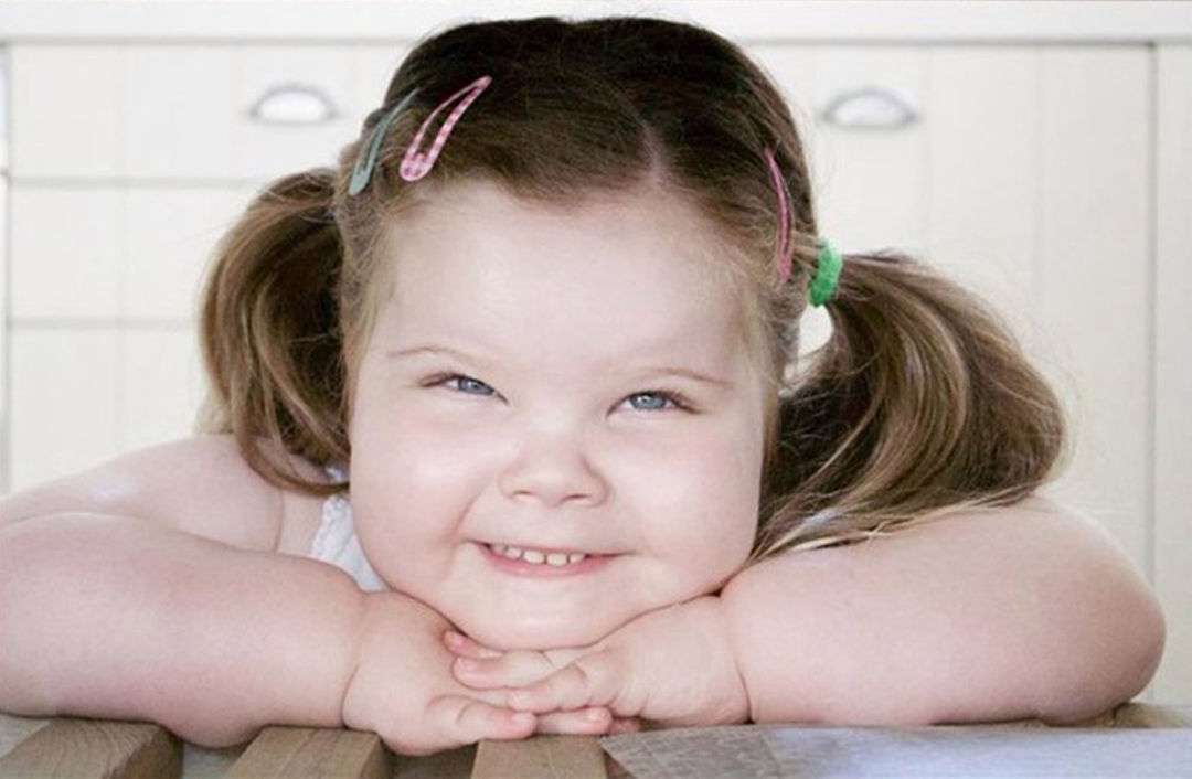 小女孩患罕见病4岁体重就超过8岁孩子,并且无