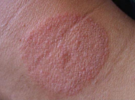 金钱癣的症状有哪些,快速治疗有妙方 金钱癣的症状有哪些,快速治疗有妙方