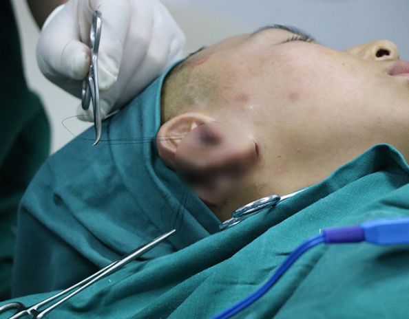 耳垂裂手术缝合的照片图片