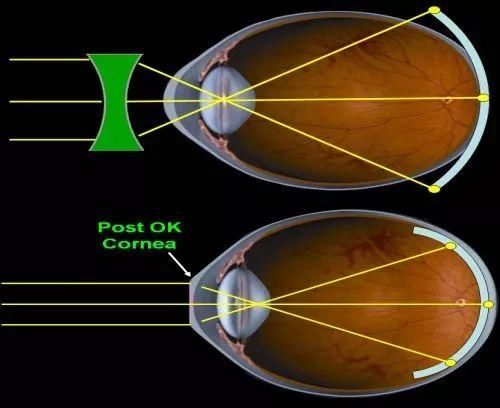 OK镜预防近视加深到底OK不OK?
