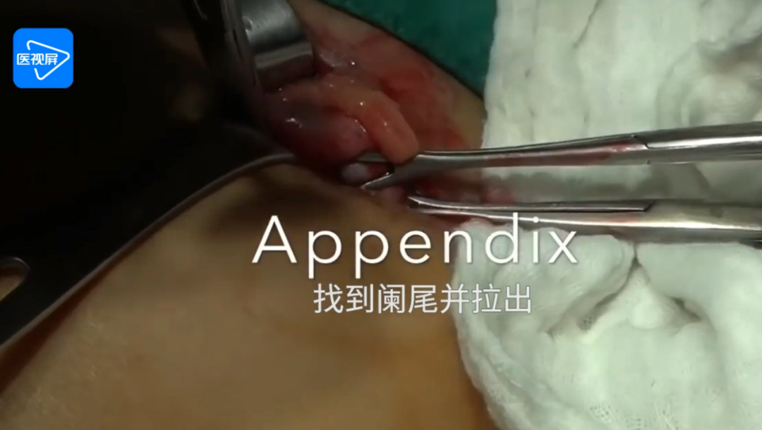 如系膜不肥厚,可用血管钳贴近阑尾根部戳孔,带线一次集束结扎,包括