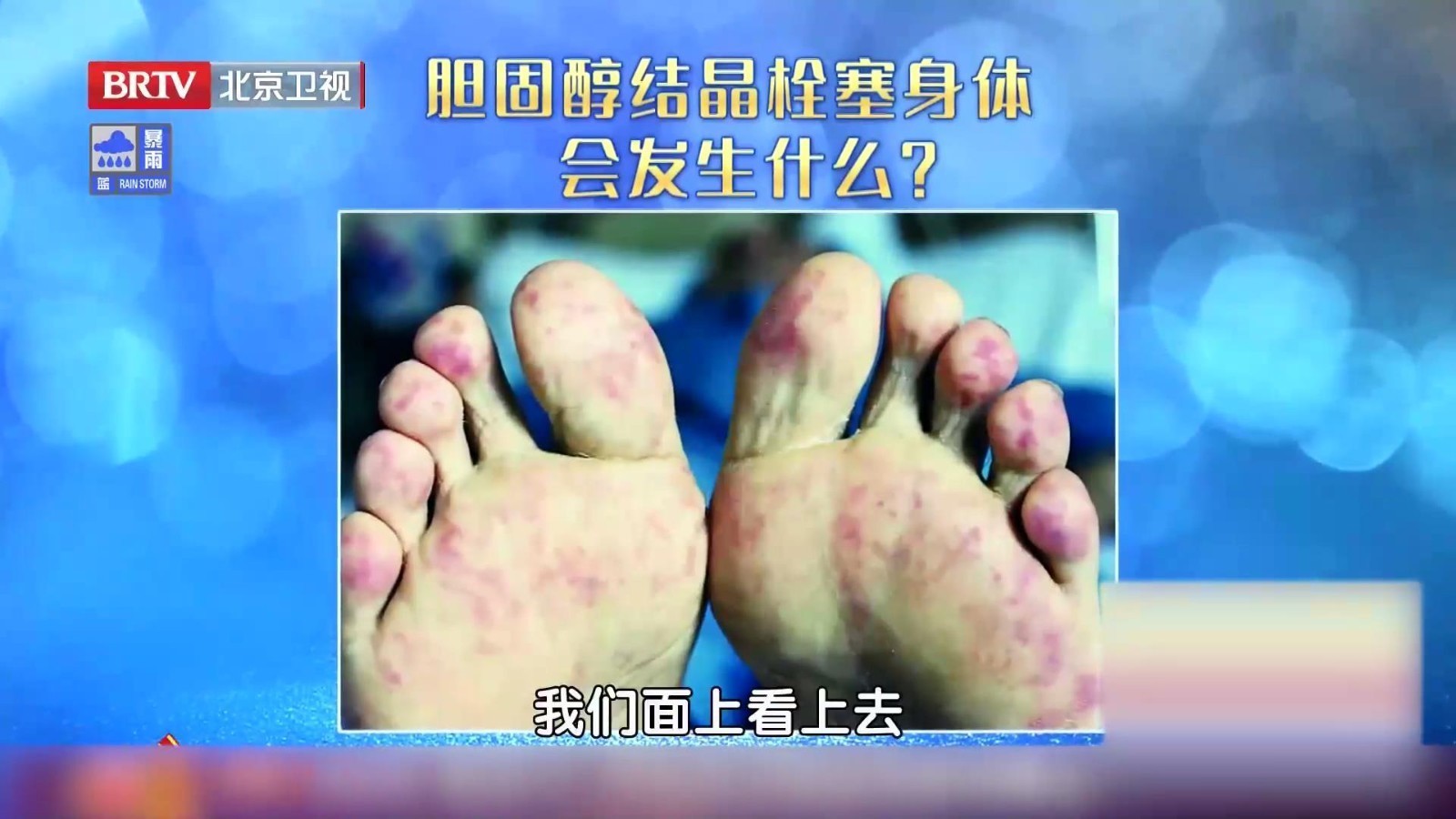 皮肤上有点状、块状甚至网状的青斑,是胆固醇结晶的典型表现 皮肤上有点状、块状甚至网状的青斑,是胆固醇结晶的典型表现