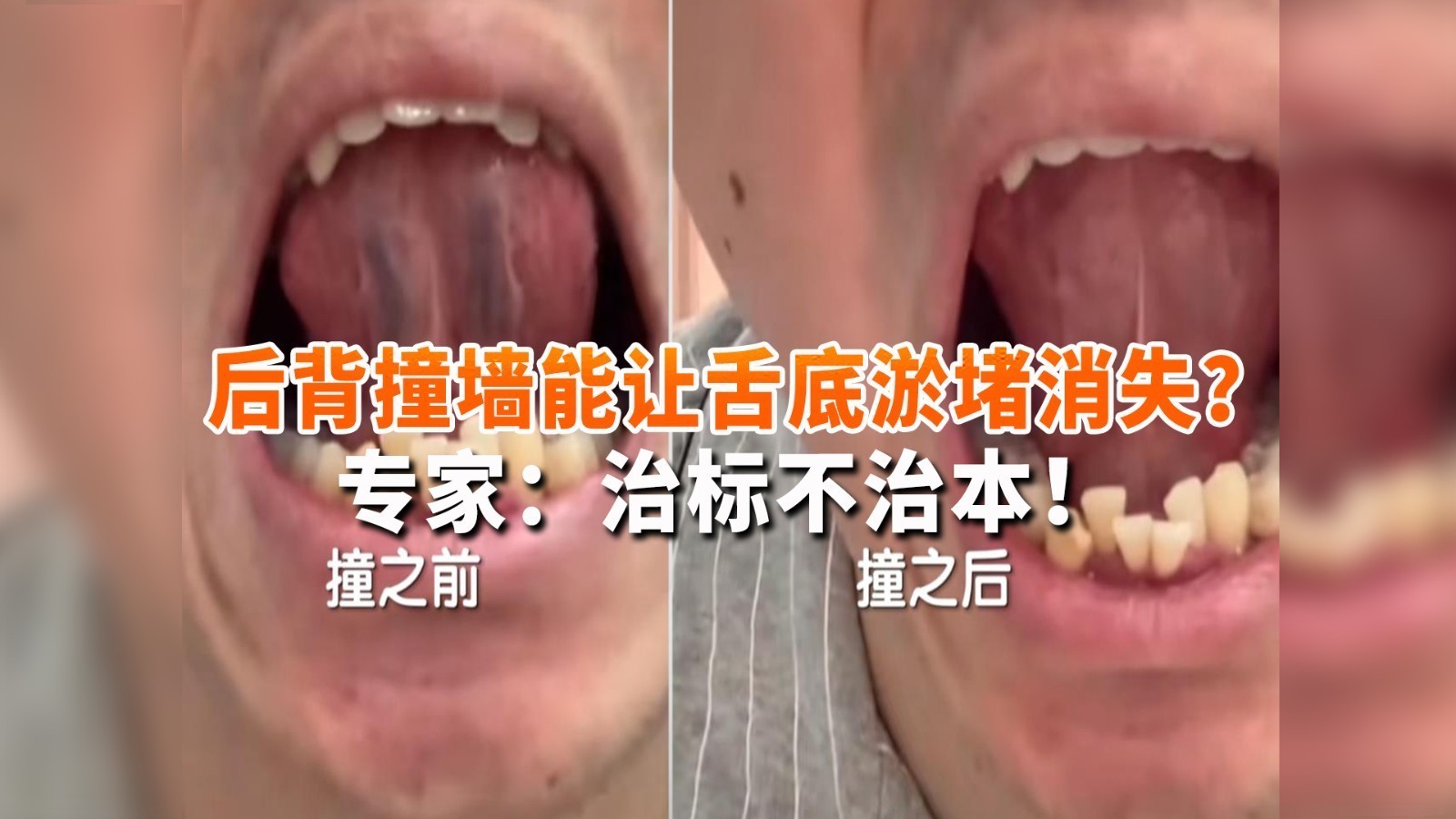 后背撞墙能让舌底淤堵消失?专家:运动也能达到,但治标不治本! 后背撞墙能让舌底淤堵消失?专家:运动也能达到,但治标不治本!