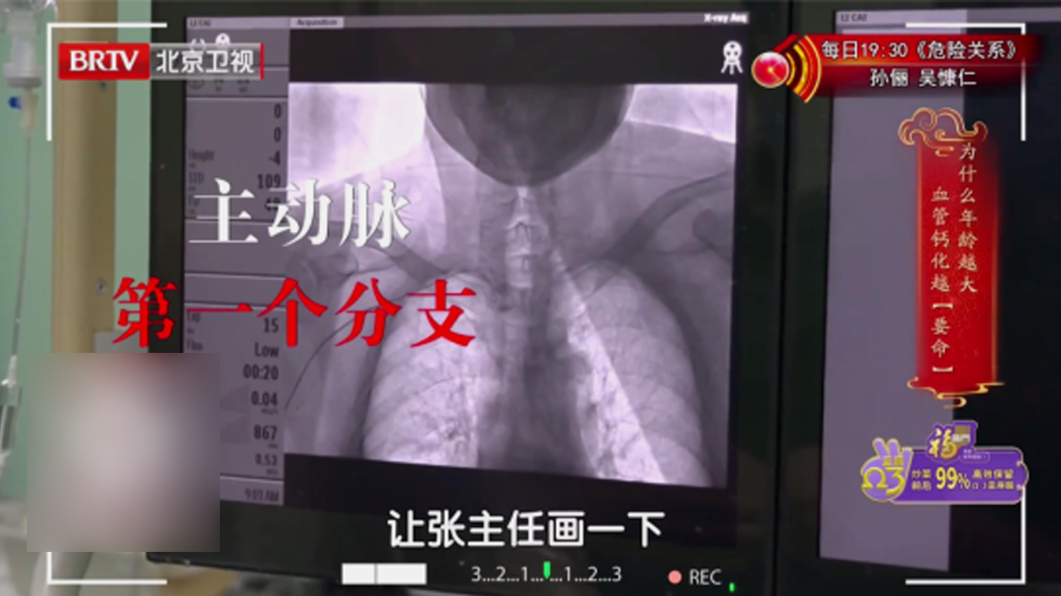 严重钙化怎么治,2项技术破局。 严重钙化怎么治,2项技术破局。